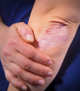 A bőrbetegségek ájurvédikus kezelése | TermészetGyógyász Magazin